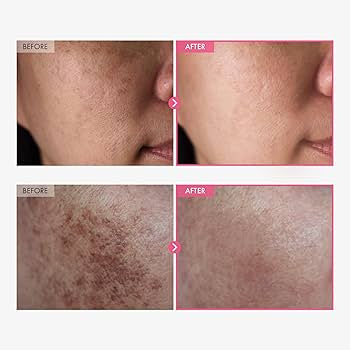 TOSOWOONG Arbutin 7% + Tranexamic Acid 4% Cream, 70,000ppm Arbutin, 40,000ppm TXA, Niacinamide, Glutathione, Dark Spots, Freckle, Blemishes, Pigmentation, Korean Skin Care, 50ml, 1.69 fl.oz.